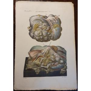 Color Engraving Anatomical Pathology Ovarian Cyst Disease By Jean Cruveilhier 1839