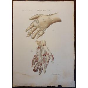 Color Engraving Anatomical Pathology Disease Of The Veins By Jean Cruveilhier 1839