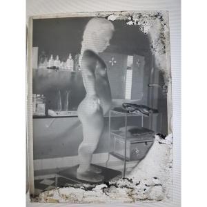 Pair Of Gelatin Silver Bromide Negative Plates Medical Curiosity Object - Dwarfism Child