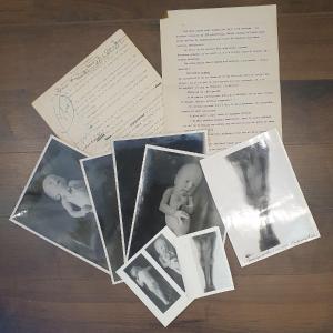 Historical Teratological Medical File On A Case Of Sirenomelia, 1936