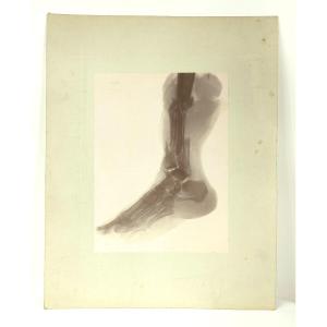 X-ray Of A Leg - Late 19th-early 20th Century 