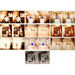 Photographs 13 Medical Stereos Gynecology Circa 1900 - 1920